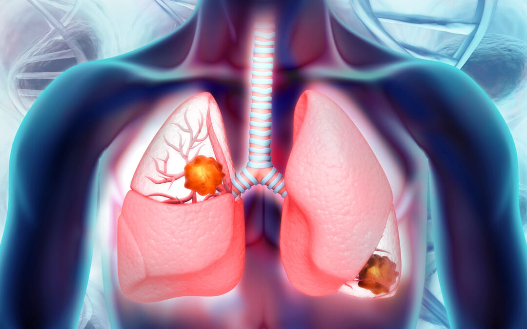 Mutation in lung cancer patients linked to increased risk of brain metastases