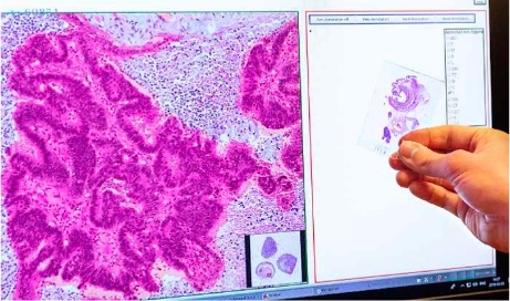 En av fem patienter med HPB-cancer kan få nya behandlingsmöjligheter
